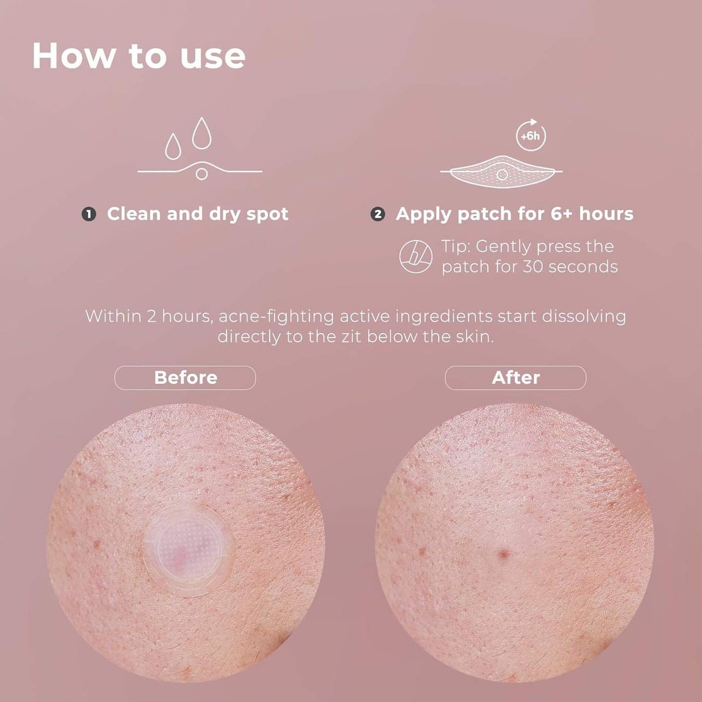 OMMA Korean Microdart Acne Patch, Cystic Acne Treatment, Micropoint Pimple Patches for Face for Early-Stage Painful Zits, Salicylic Acid & Tea Tree - 14 mm Zit Stickers (18 Count)