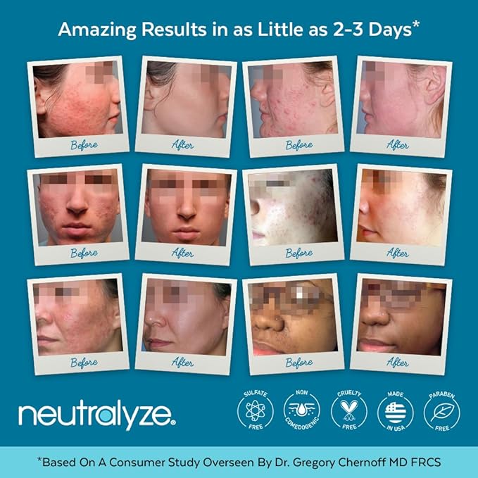 Moderate To Severe Acne Treatment Kit 2.0 - Maximum Strength Acne Kit, 2% Salicylic Acid, 2% Mandelic Acid & Nitrogen Boost Skincare Technology - Acne Treatment for Teens & Adults (90+ Day)