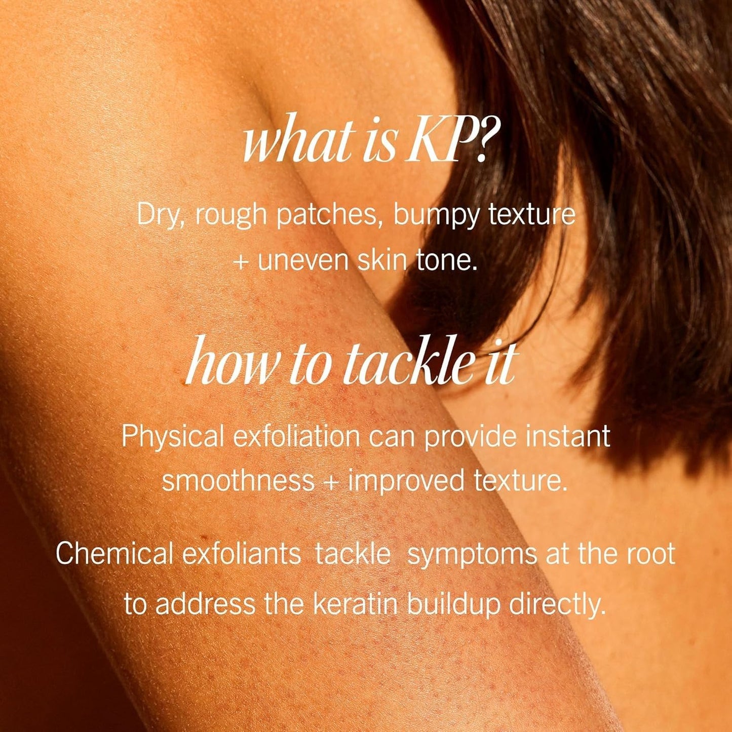 First Aid Beauty - KP Bump Eraser Body Scrub with 10% AHA, Keratosis Pilaris Skin Exfoliator with Glycolic and Lactic acids, Helps Reduce Chicken Bumps, Safe for Sensitive Skin, 2 oz